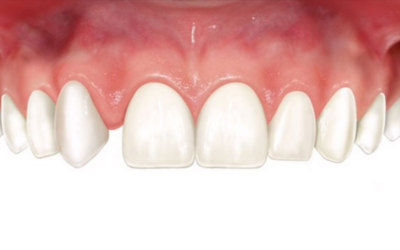 Che cos’è l’agenesia di un dente?