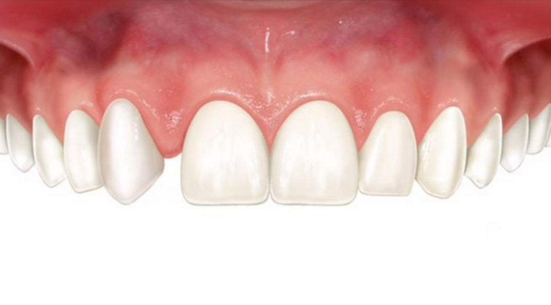 Che cos’è l’agenesia di un dente?